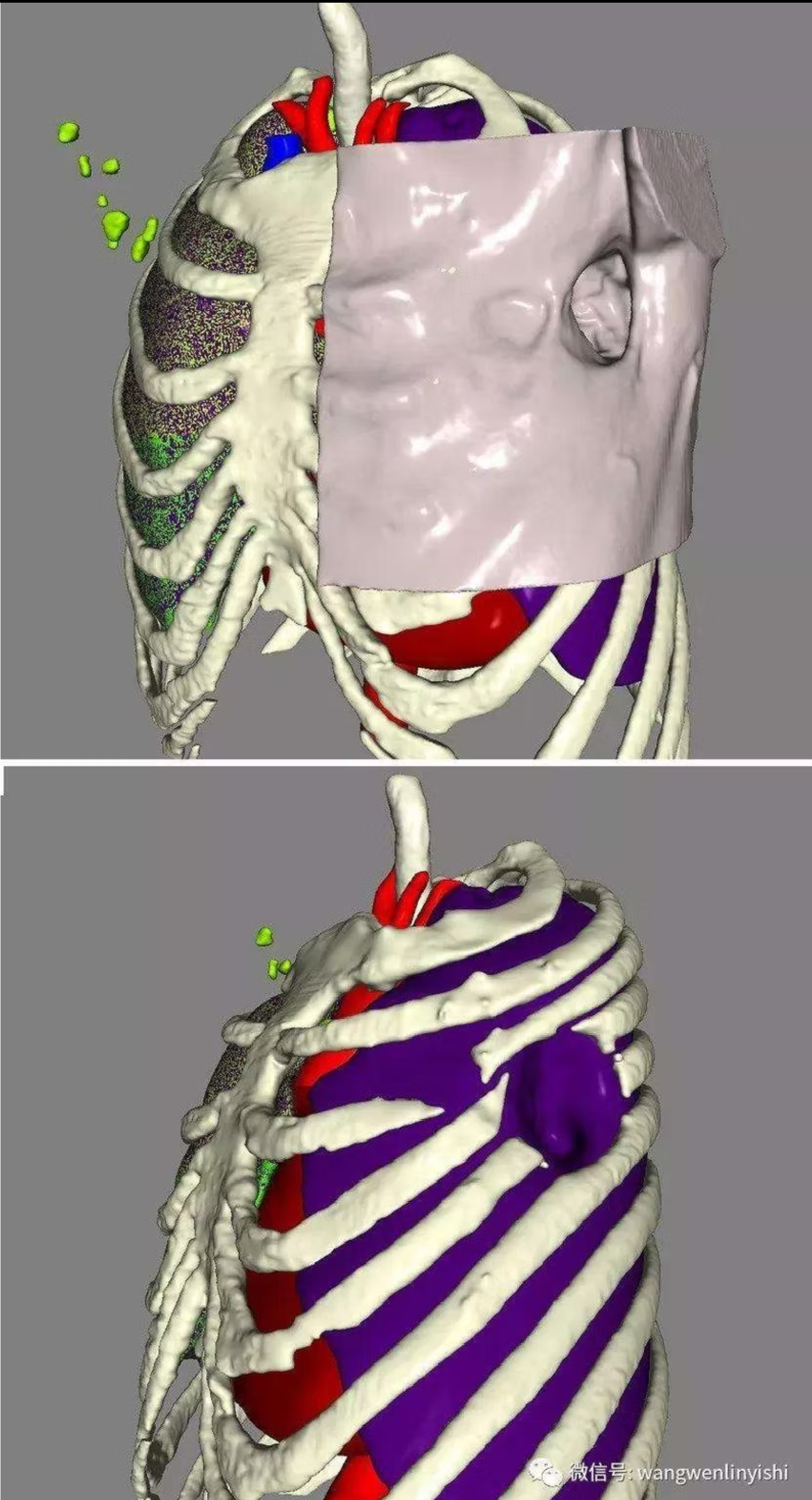 3D reconstruction showing the location of the chest wall defect