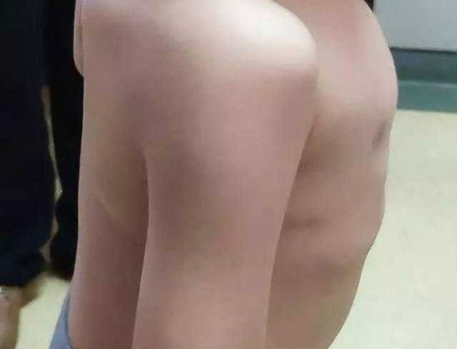 The anterior chest wall protrudes, with a loss of normal spinal curvature