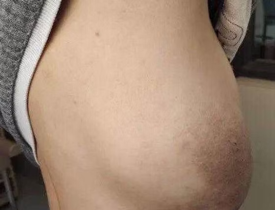 A large tumor located on the right chest wall
