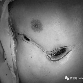 The incisions