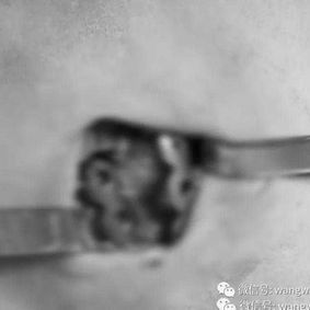 surgical incision