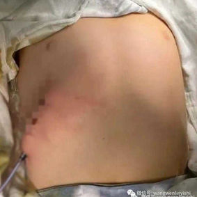 after surgery