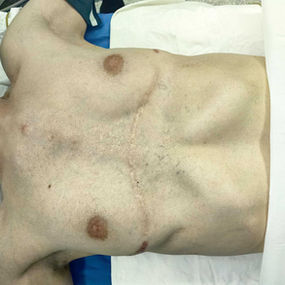 The chest wall shows a severe abnormality, featuring multiple old surgical scars, a large central depression, and prosthetic bulges on both sides.