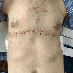 After surgery, the chest has returned to its normal size, and the narrowing has been eliminated.