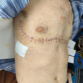 After surgery, the chest has returned to its normal size, and the narrowing has been eliminated.
