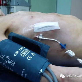 The chest wall appearance returned to normal after the surgery