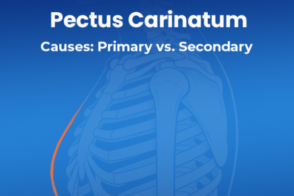 Understanding Pectus Carinatum Causes: Primary vs. Secondary