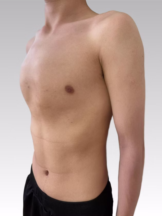 pectus carinatum