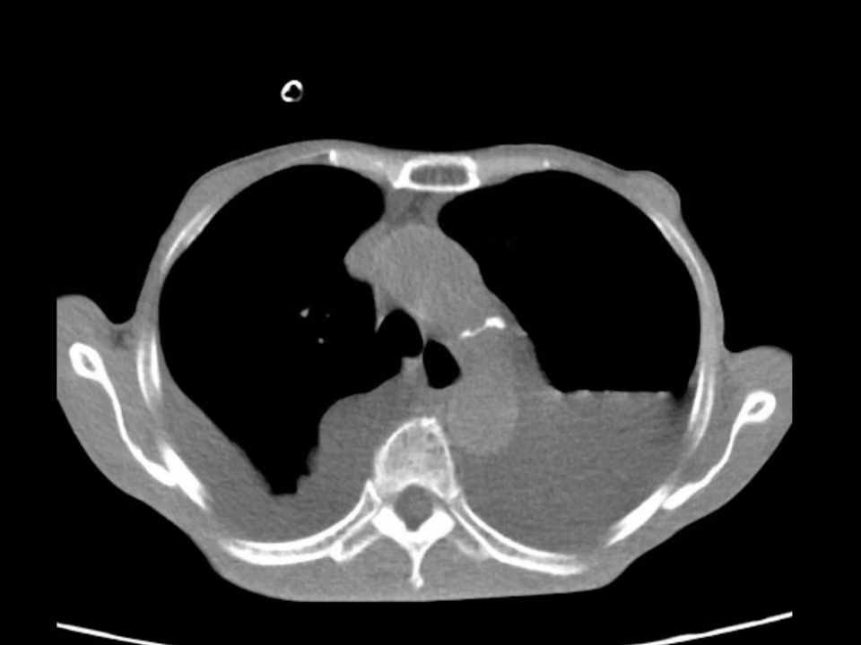 Chest CT of the patient with chylothorax shows massive bilateral pleural effusions
