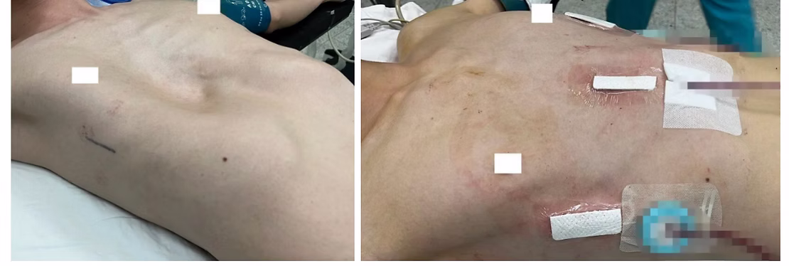 Adult Asymmetrical Pectus Excavatum: Before & After Surgery