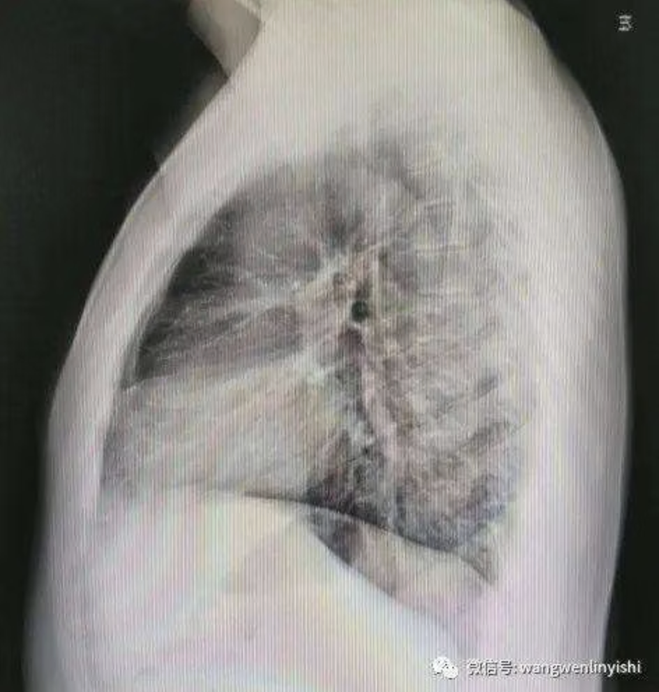 The X-ray image indicates a severe chest wall deformity