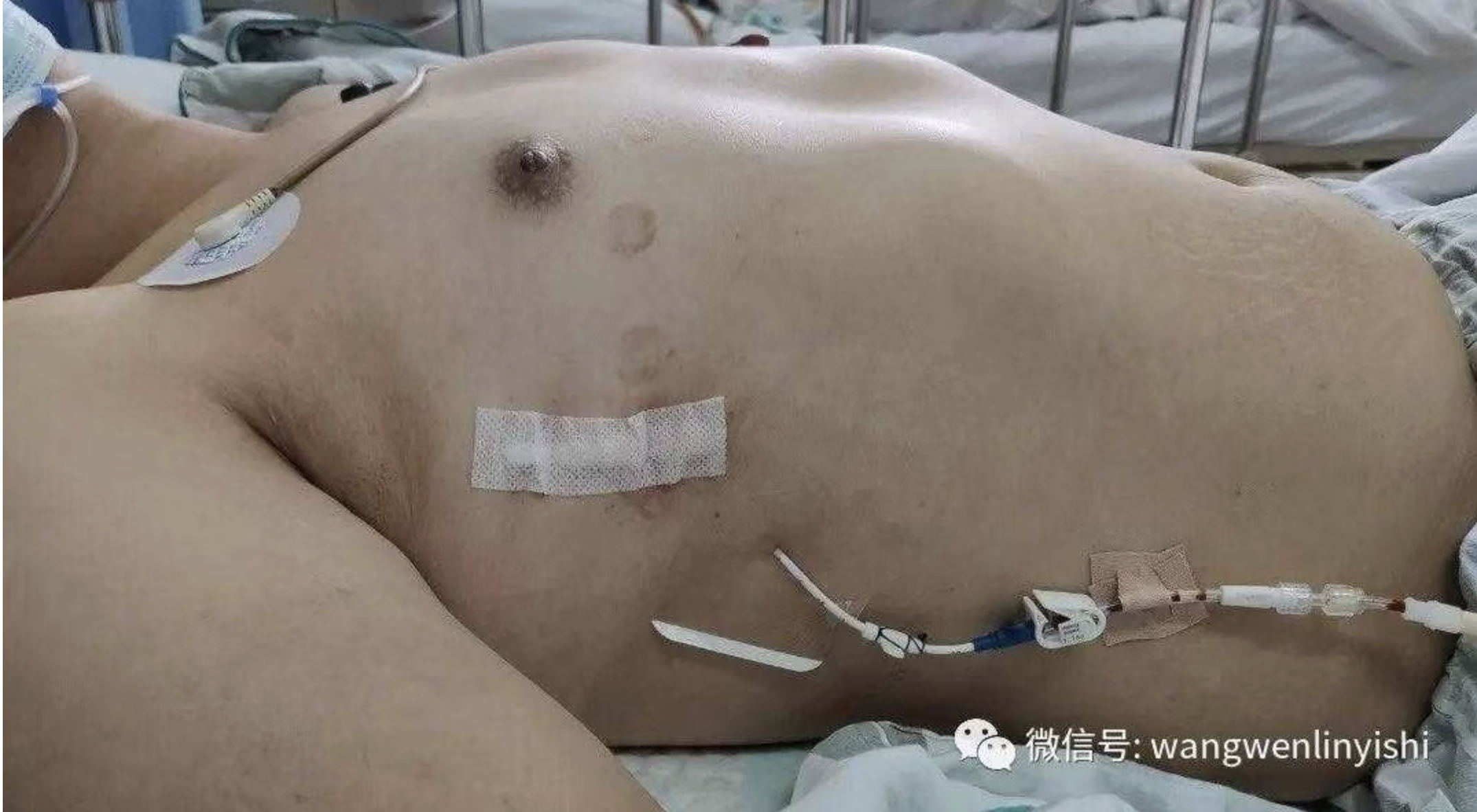 The chest wall has basically returned to normal after the surgery
