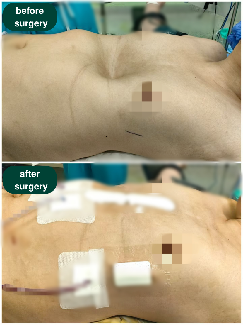 before surgery and after surgery -  chest wall deformity ICWS