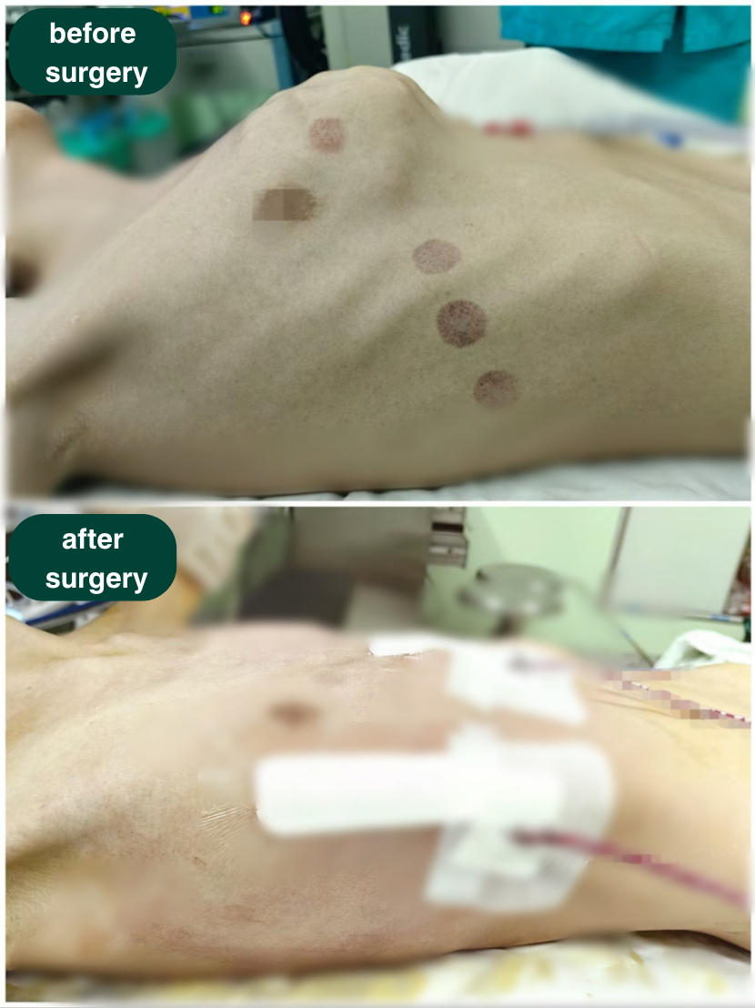 before surgery and after surgery -  chest wall deformity ICWS