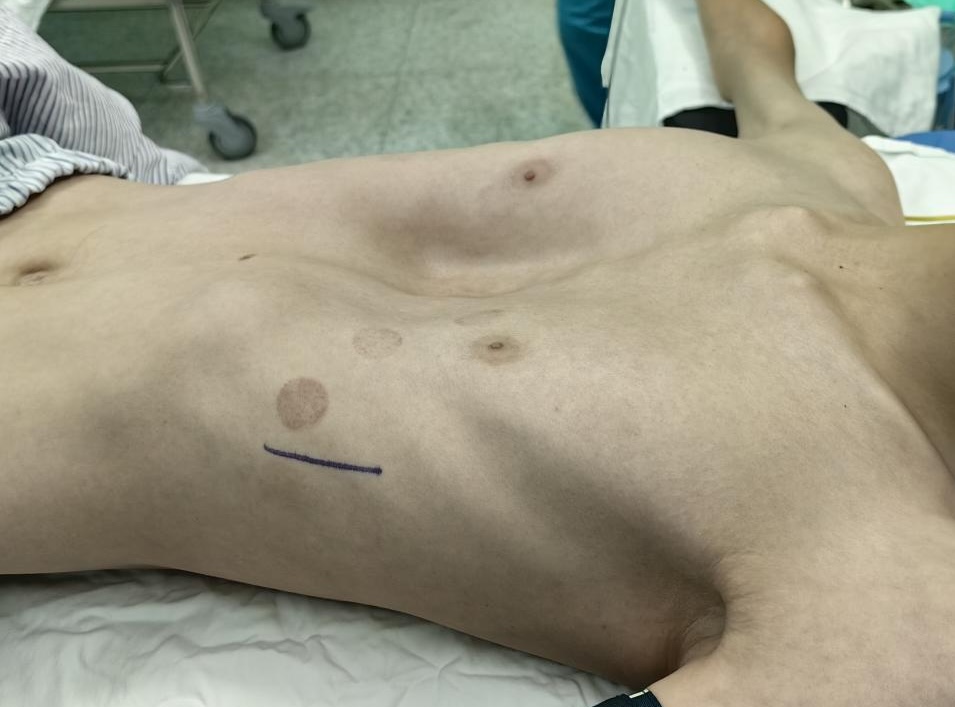 pectus excavatum