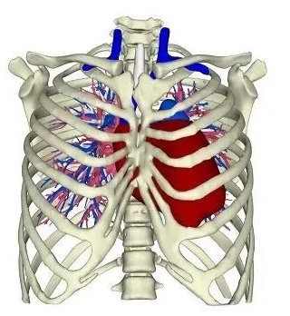 Significant gap and instability between the two sternal halves following cardiac surgery
