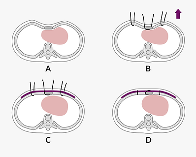 surgical technique of the Wang procedure