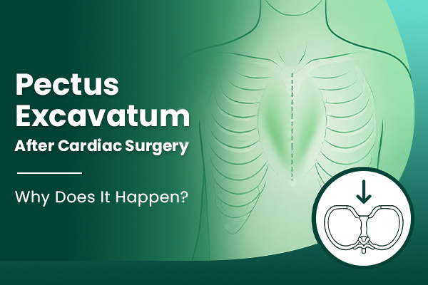 Why Does Pectus Excavatum Occur After Cardiac Surgery?