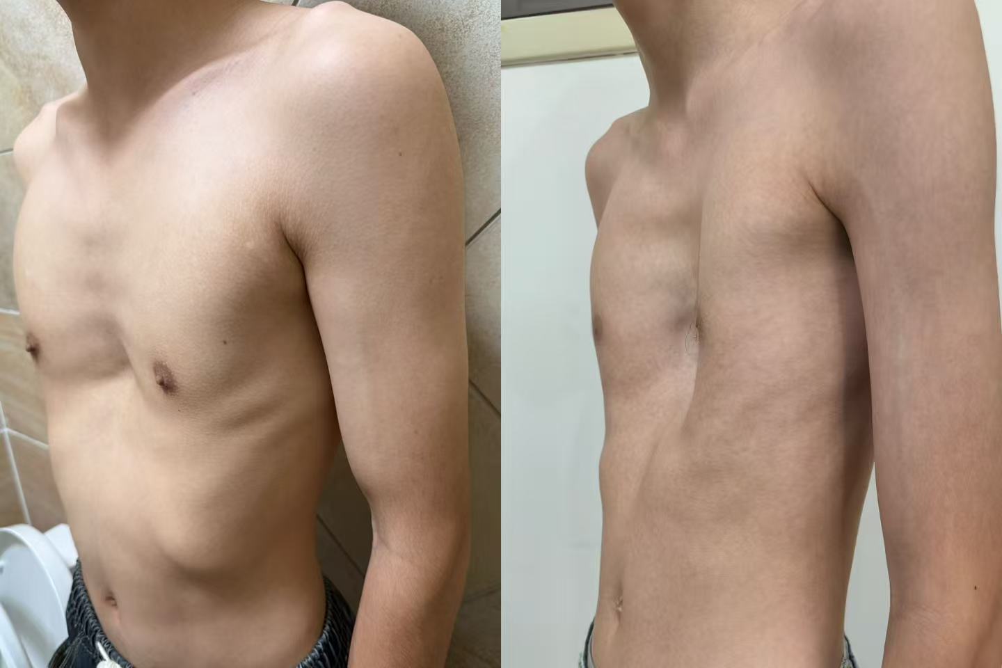 pectus excavatum: mild vs. severe