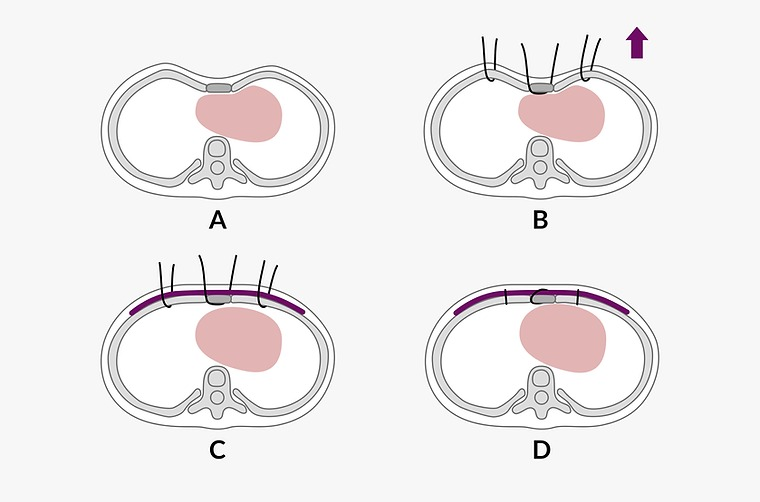 wang procedure