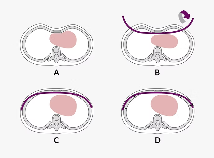 wung procedure