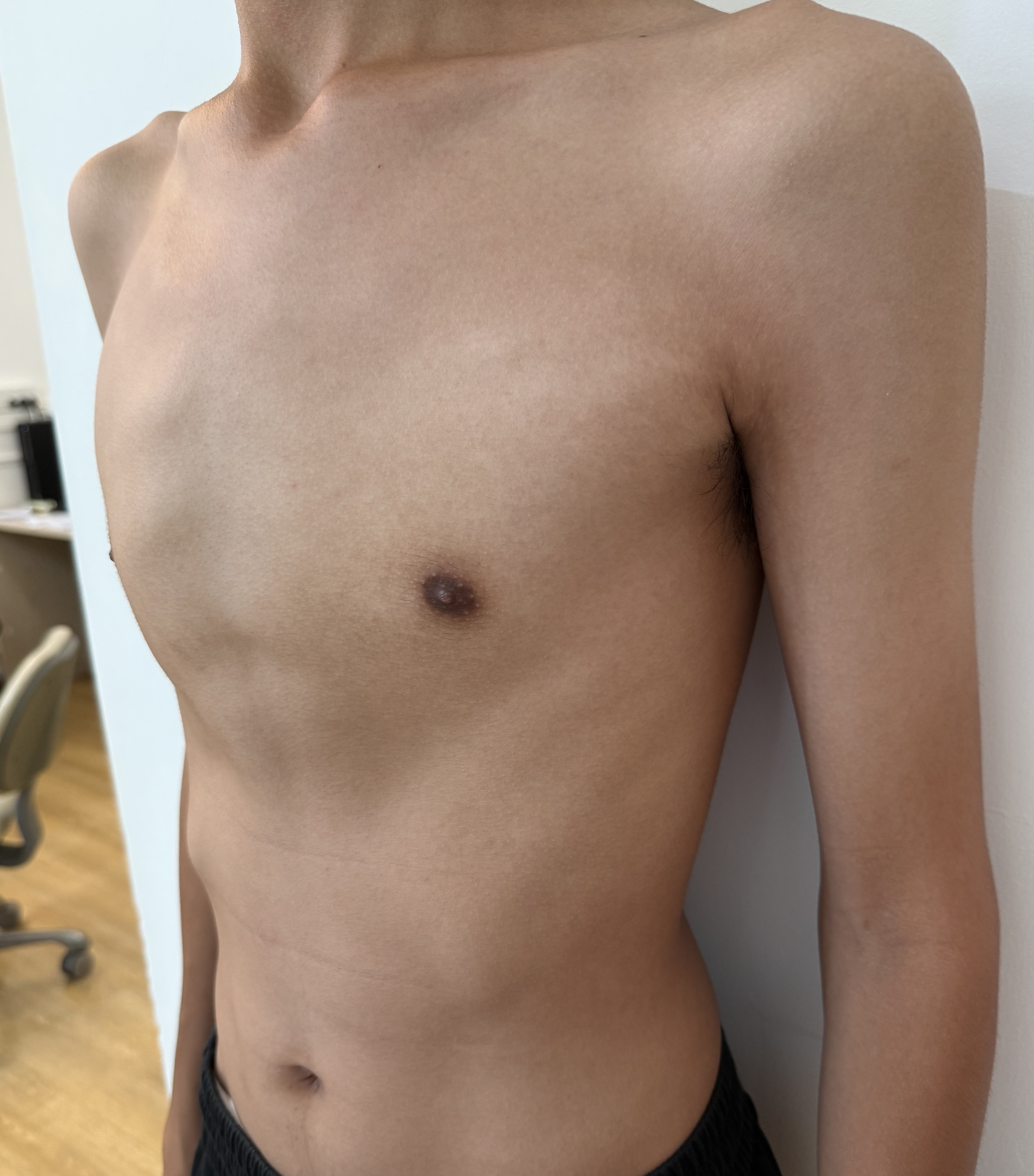 pectus carinatum