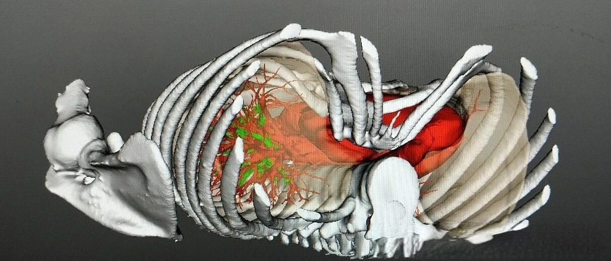 3D reconstruction showing the narrowed space between the chest wall and the heart and lungs