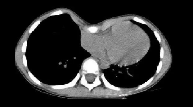 Chest CT showing cardiac compression caused by pectus excavatum