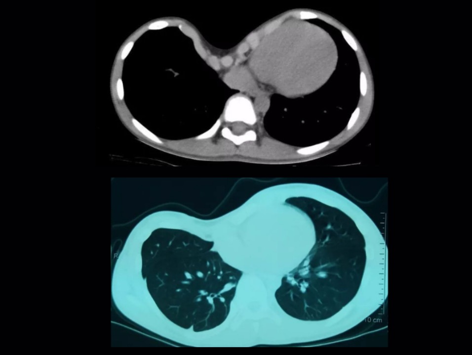 CT comparison of common(Top) and malignant(Bottom) pectus excavatum