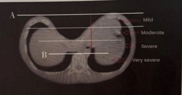 Wenlin Index for grading pectus excavatum severity
