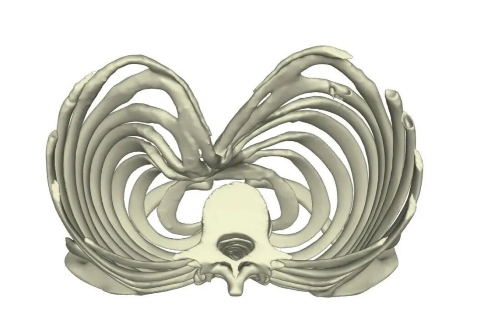 3D reconstruction of pectus excavatum