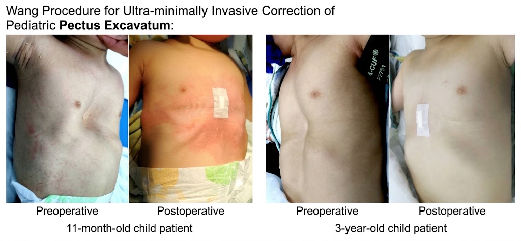 Ultra-minimally invasive Wang procedure for pectus excavatum in young children